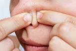 Cara Menghilangkan Komedo Hitam di Hidung dengan Mudah